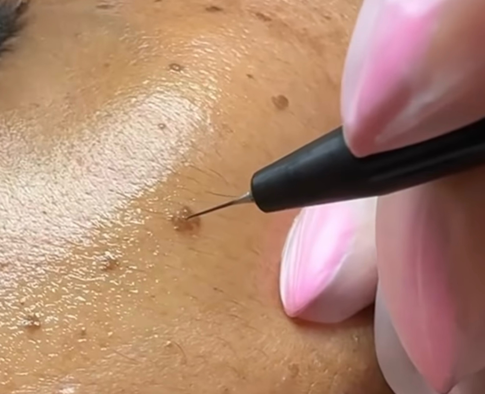 Sebortheis Keratosis Removal