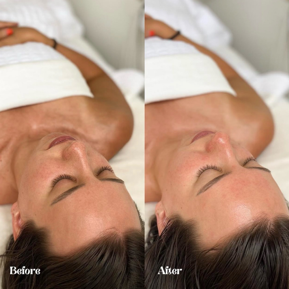 Dermaplane Facial at Fresh Till Death Esthetics in Beacon, NY