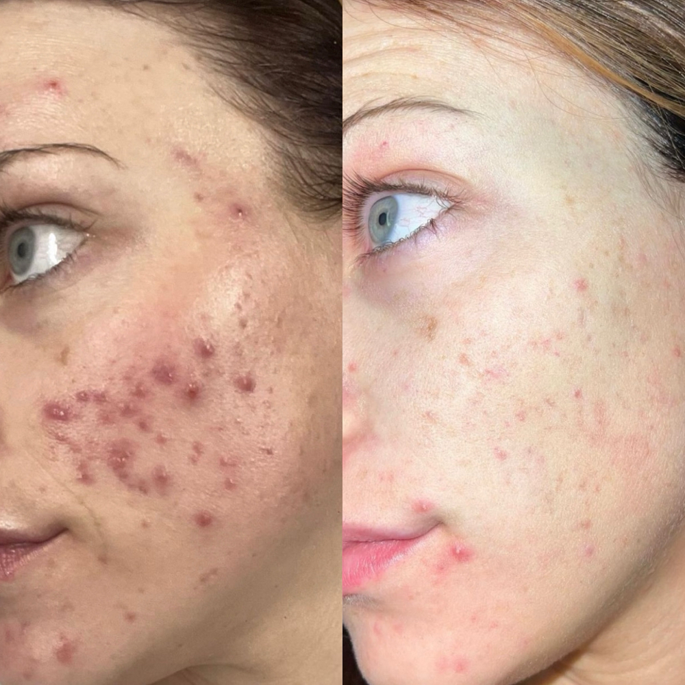 ACNE BOOTCAMP