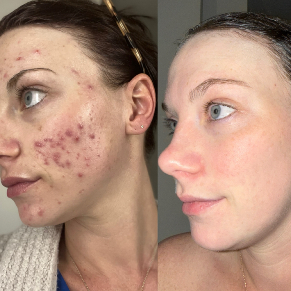 ACNE BOOTCAMP at Hanssy Esthetics in Boynton Beach, FL