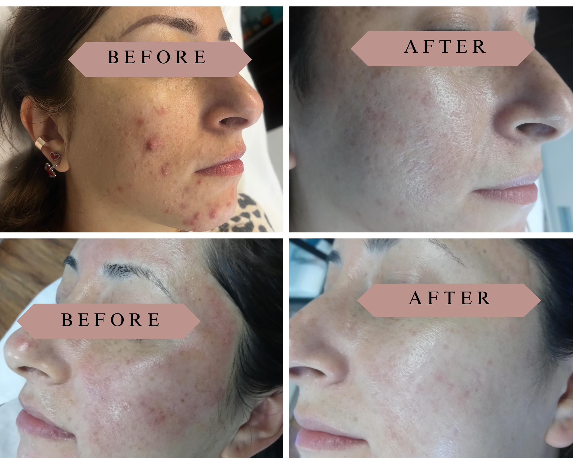 Acne Facial Treatment at Oasis Healing Esthetics in Los Angeles, CA
