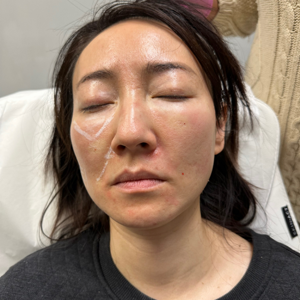 PRF liquid at Atelier Aesthetics and Infusions in Dallas, TX