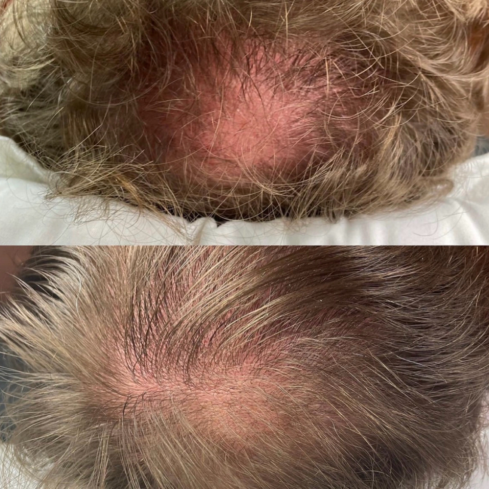 SCALP MICROCHANNELING/MICRONEEDLING at Amy Shafer Aesthetics in Nashville, TN