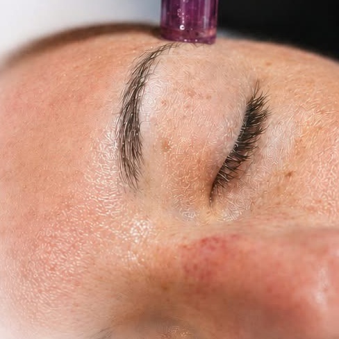 Microneedling with PDRN at Minds-N-Motion Wellness LLC in North Jackson, OH