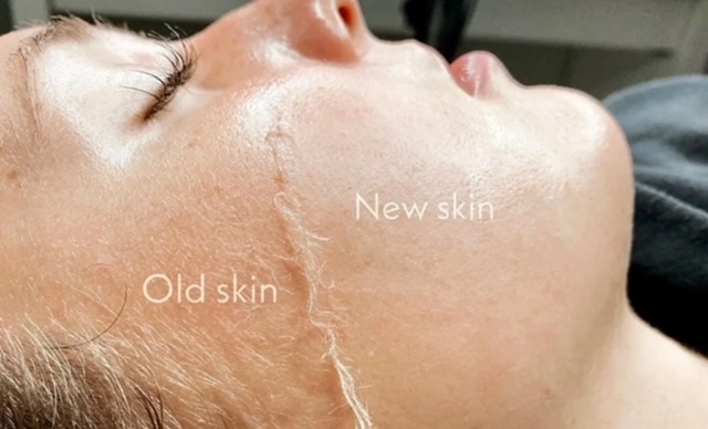 Dermaplaning Facial
