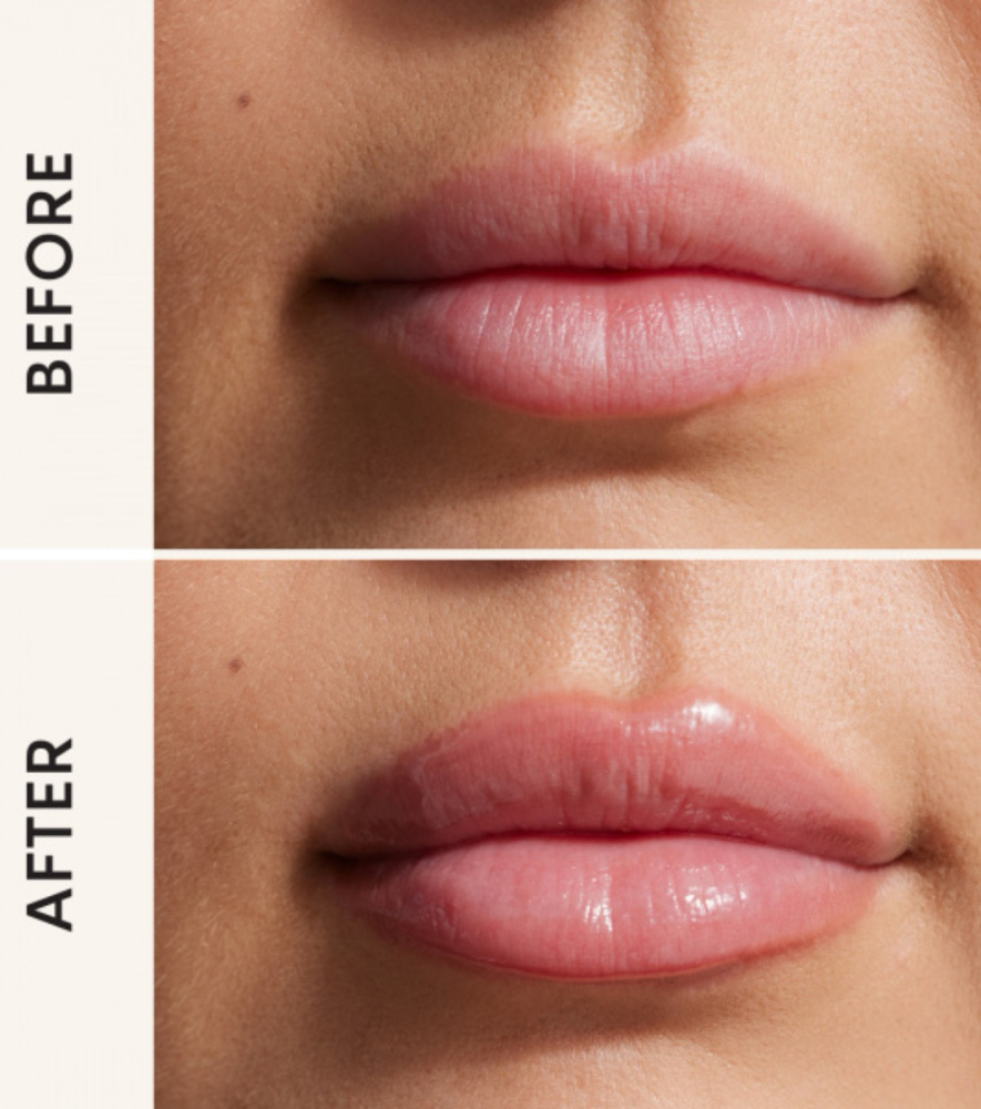 Lip Filler Half at DVASH AESTHETICS in Harlingen, TX