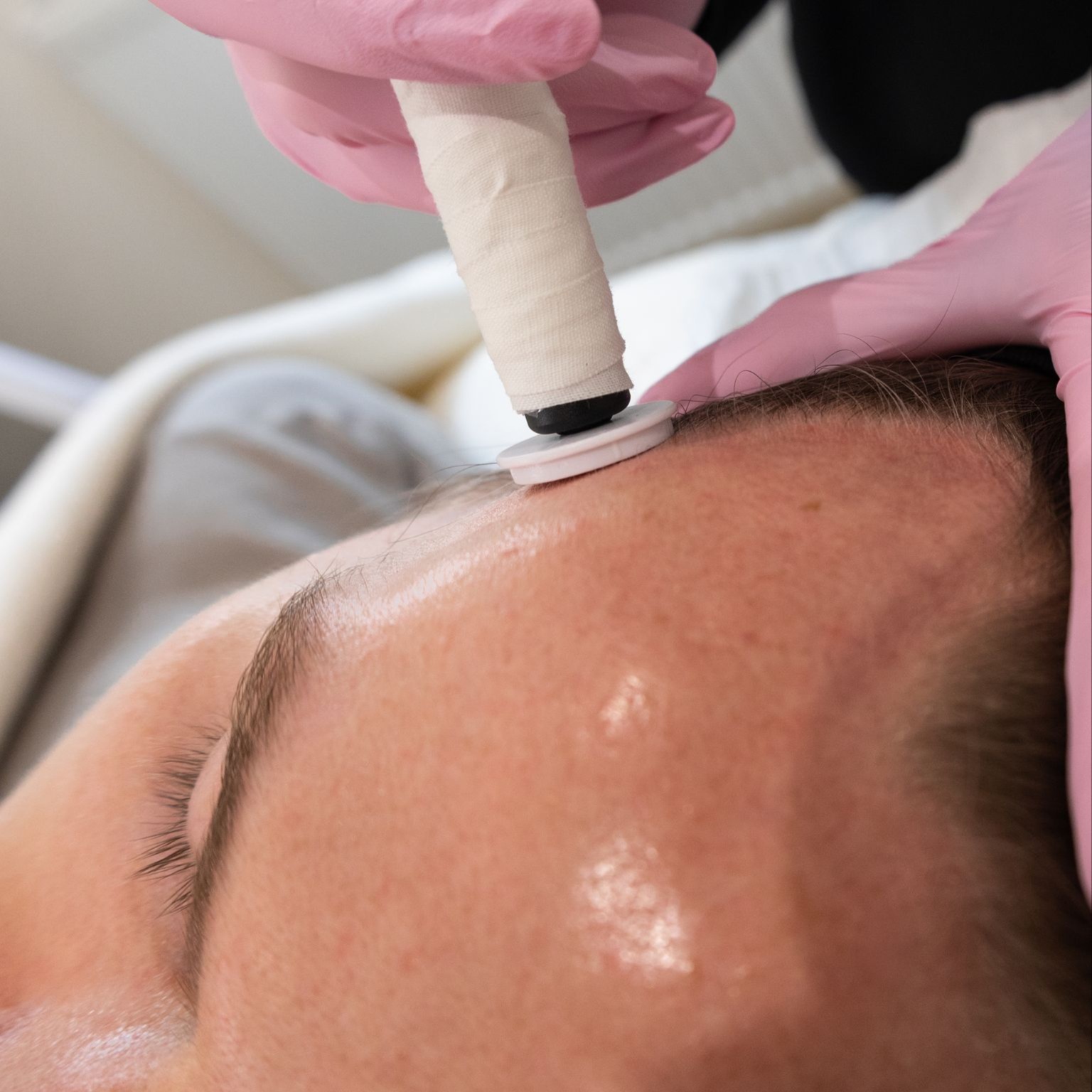Scalp Micro Channeling Series at Restore Face and Body Studio in Osage Beach, MO