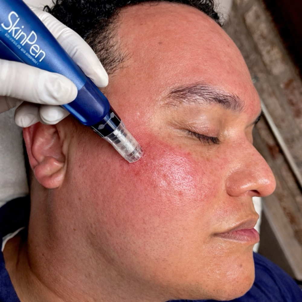 Microneedling SKIN PEN at Blurred Lines Aesthetics LLC in Waxahachie, TX