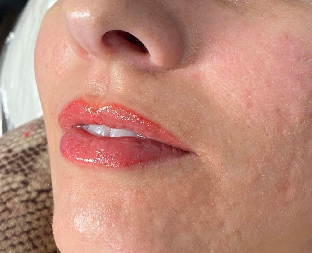 Lip Follow Up 4-6 Weeks