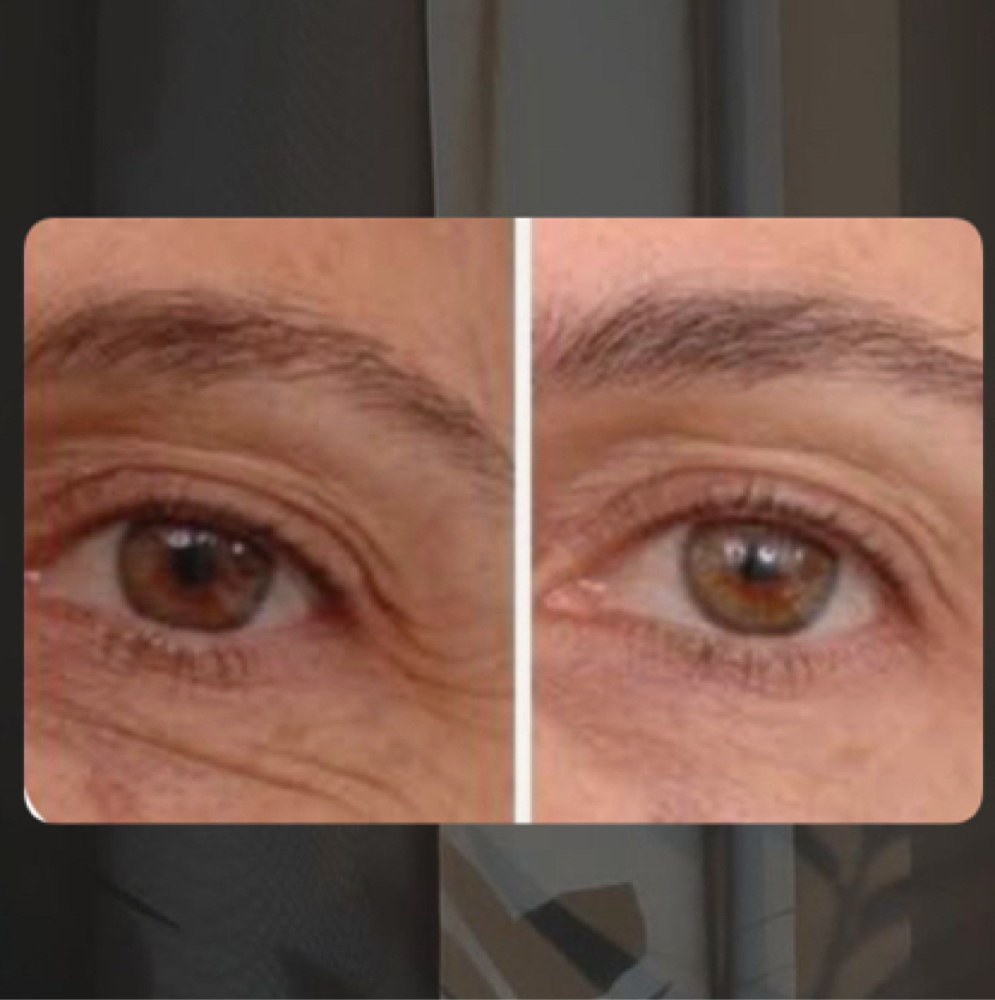 RF microneedling | eye firm (3) at Corrective treatments + professional skincare in Atlanta, GA