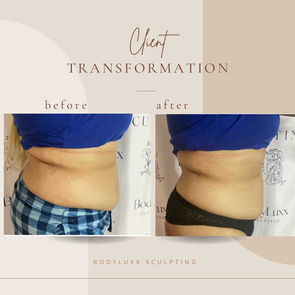 Tummy Tuck 360