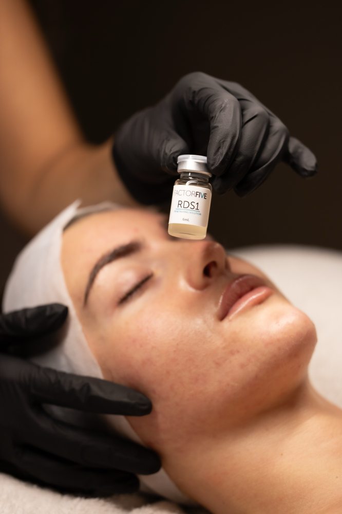 The Factor Five Peel (NO DOWNTIME)