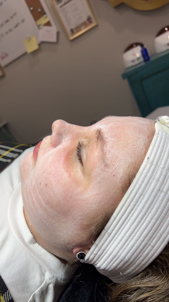 Salicylic Acid Peel