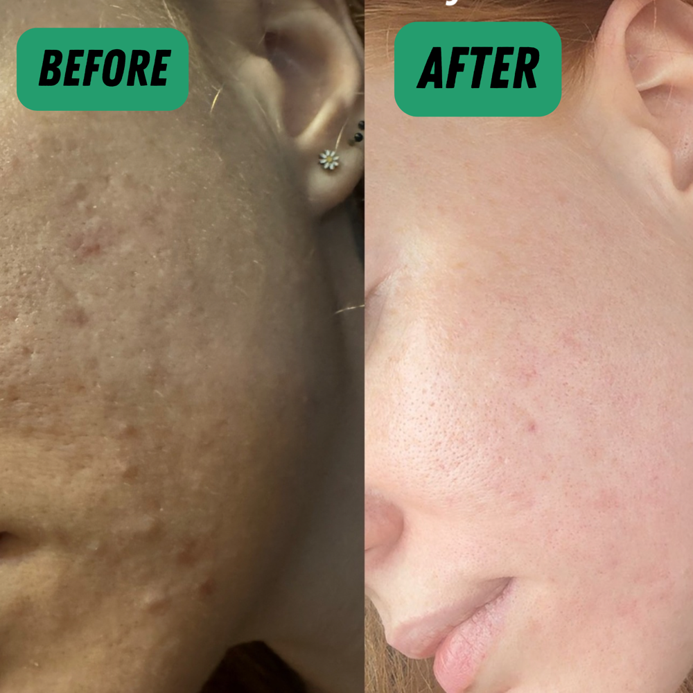 Double Peel Facial