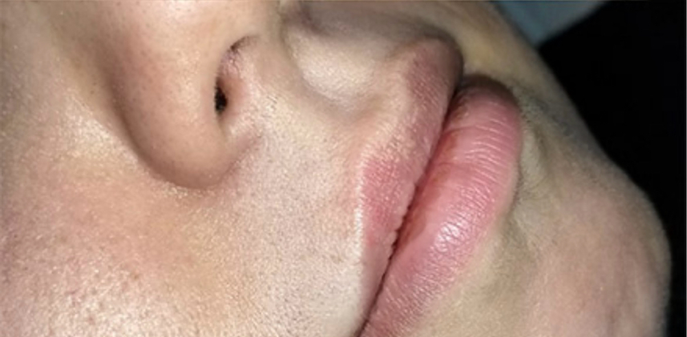 Lip/ Chin Wax