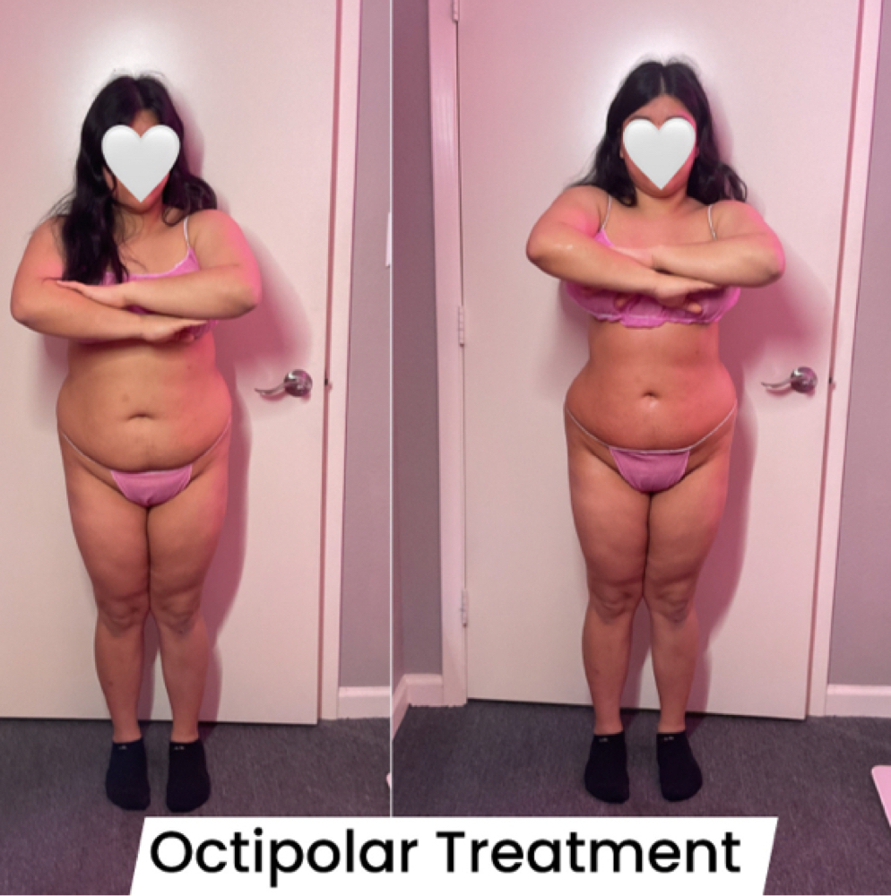 Body Contouring Octipolar at Flawless Spa & Beauty in Fort Worth, TX
