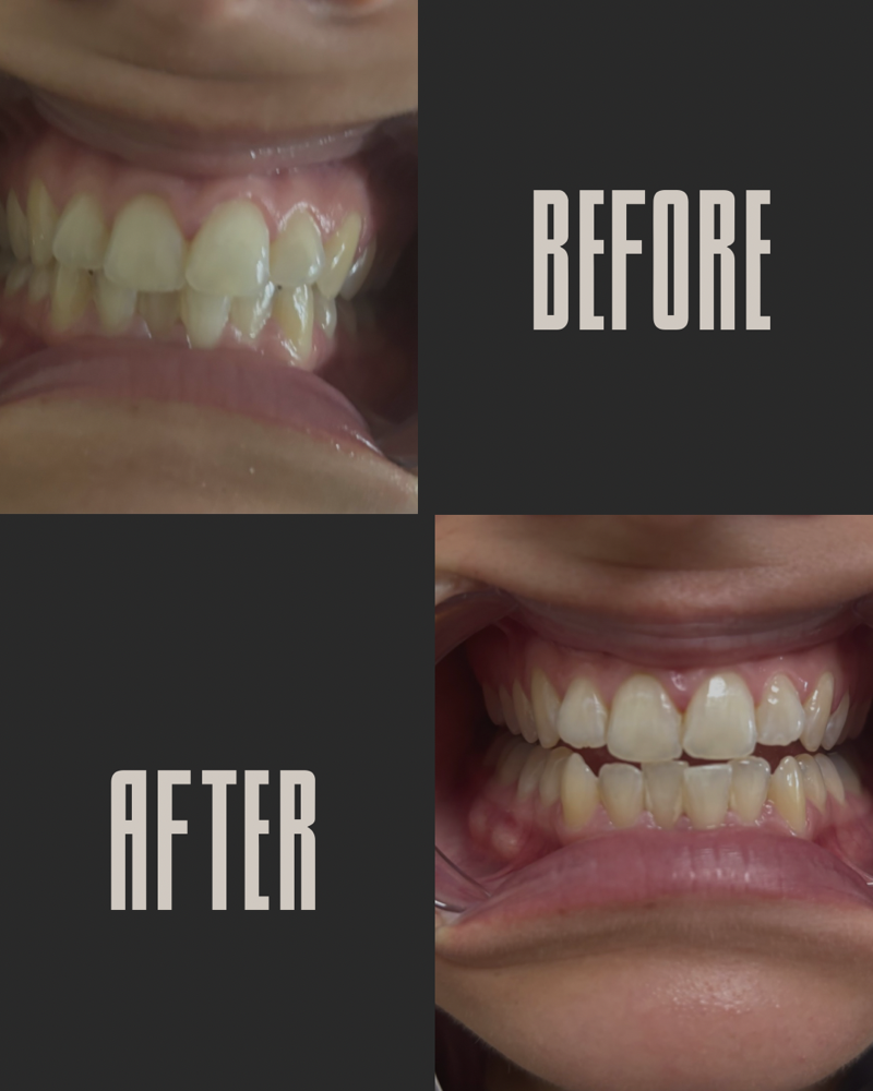 20 Minute Teeth Whitening  Touch Up
