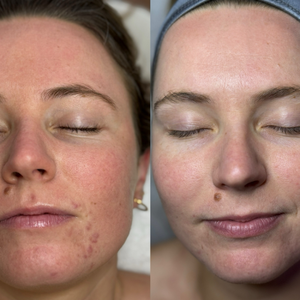 Level 3 Signature Facial at Oasiah Aesthetics in New York, NY