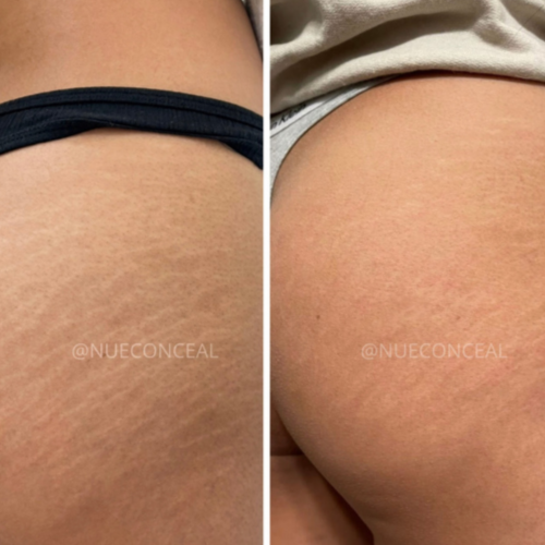 Stretchmark Camo Model Call Consult at Beauty by Radiant Strokes in Lakeland, FL