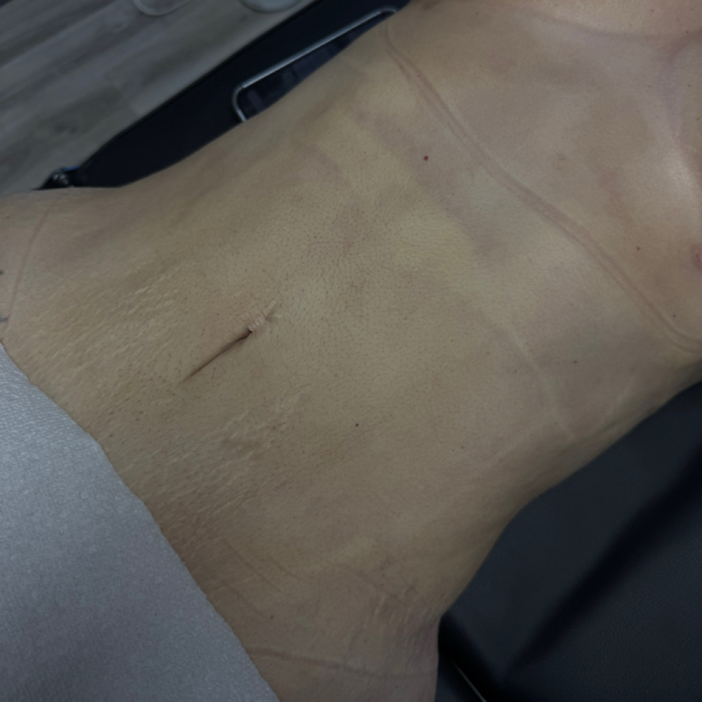 Post Op Package (7 Massages) at Liminluxx in Dallas, TX
