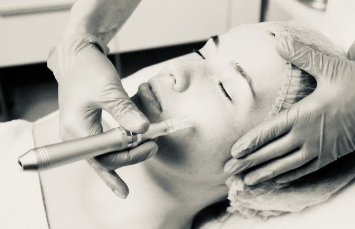 Microneedling