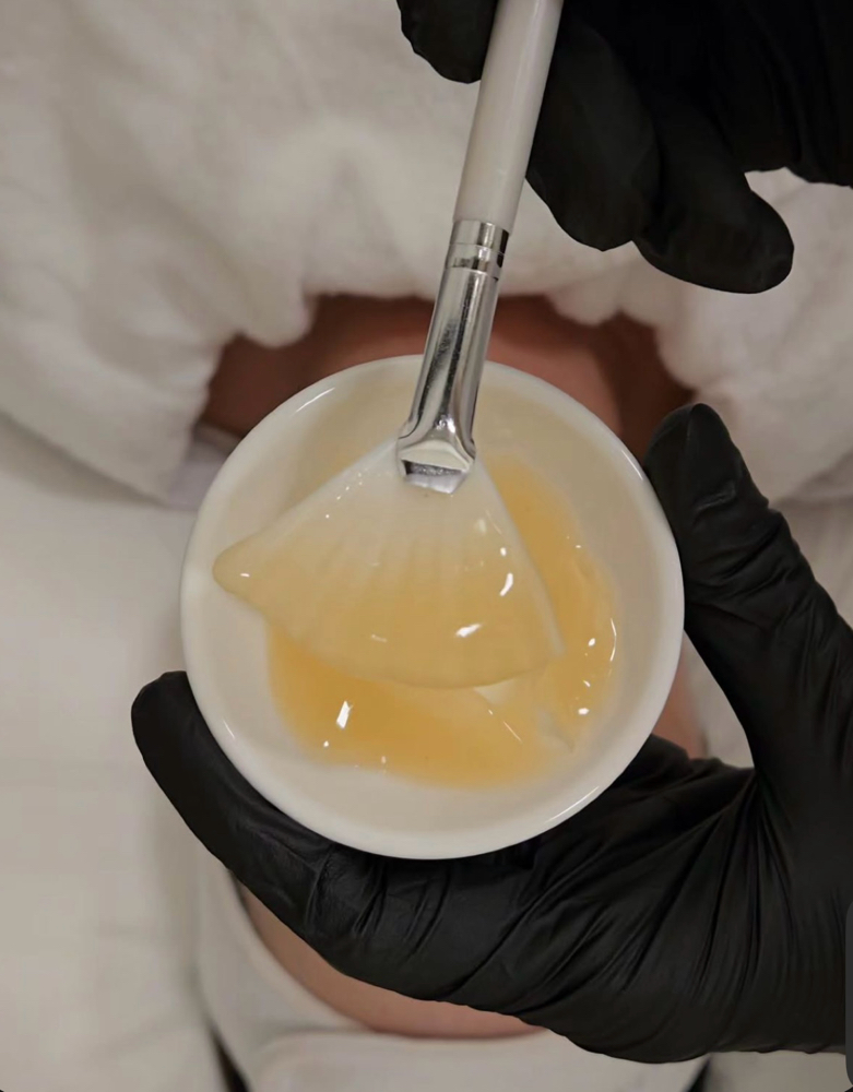 Depigmentation Peel at Glow Crazy Esthetics in Saint Joseph, MO