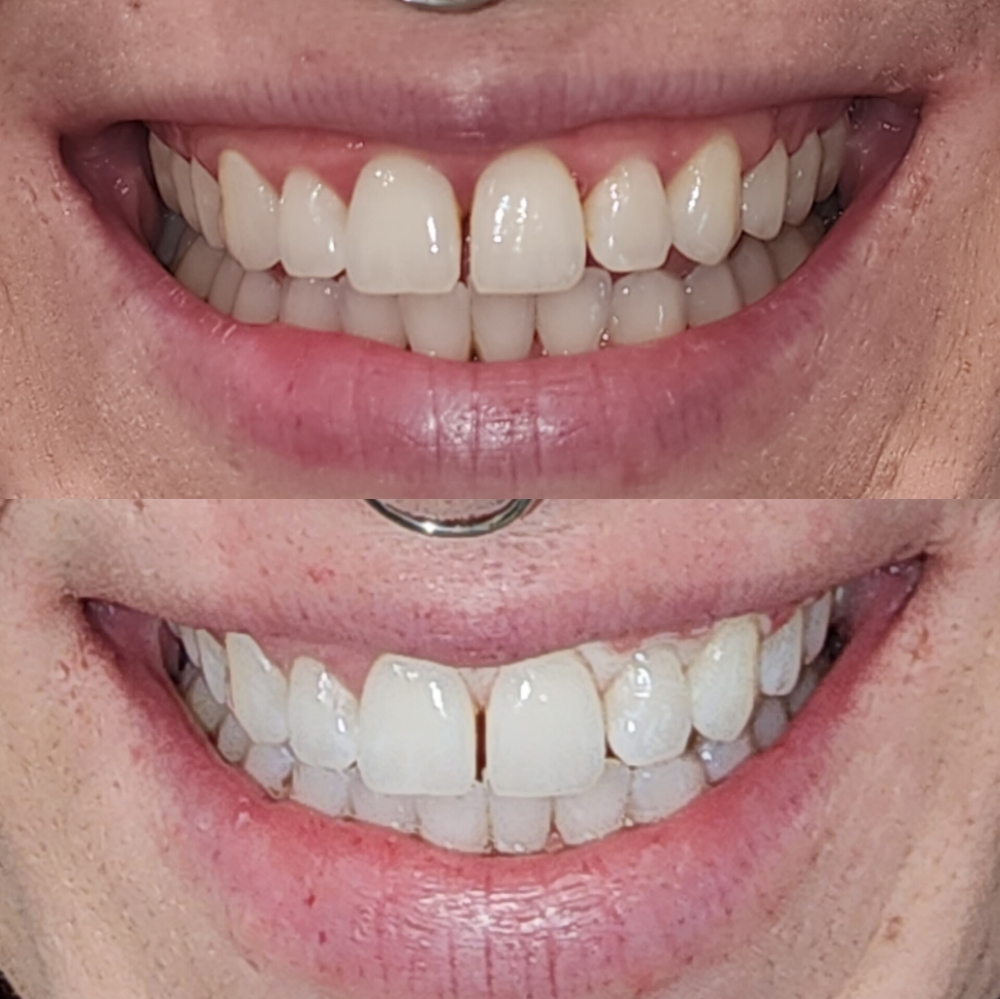 Whitening Extended Session