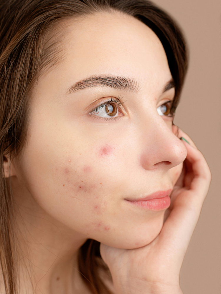 Acne Treatment Facial