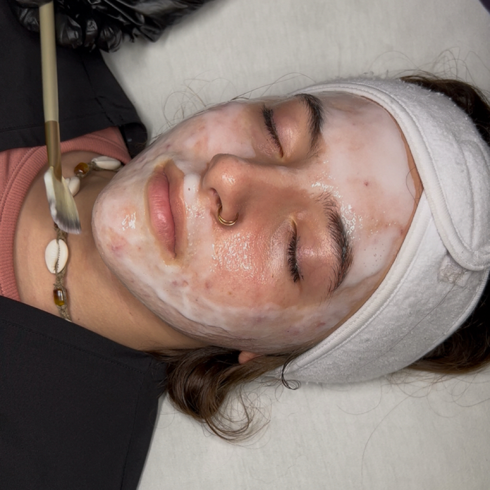 Acne Bootcamp | 8 Week Program at THE LAB in Decatur, AL