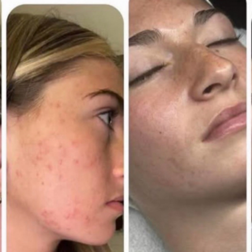 Intensive Acne Treatment at Amy Gudger, Licensed Esthetician in Kelseyville, CA