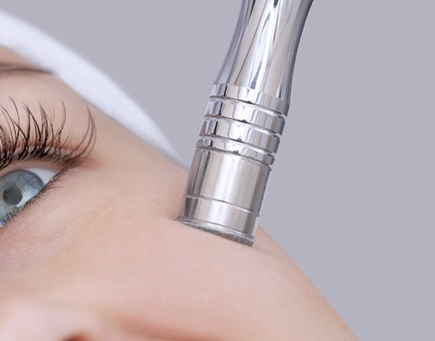 Microdermabrasion