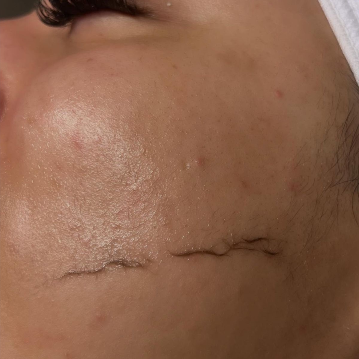 Dermaplaning Facial at KH Esthetics in Texarkana, TX