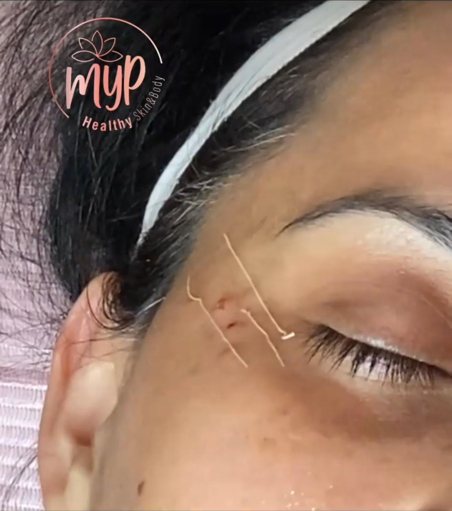 hyaluronic acid with collagen threa