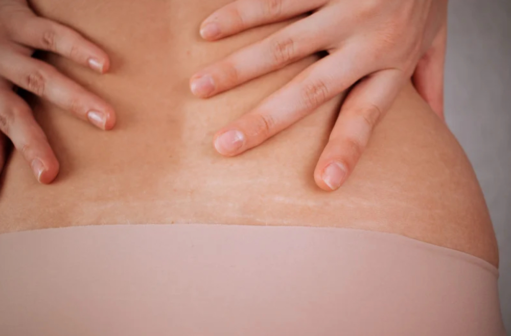 Stretch Mark Revision (Medium Area)
