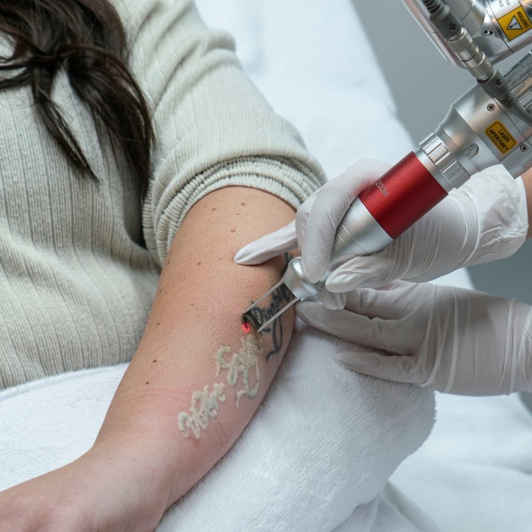 Tattoo Removal at Remake Beauty Studio San Juan in San Juan, TX