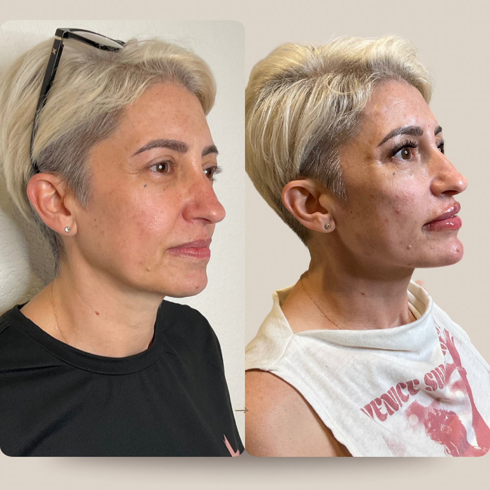 Jawline & Chin Filler