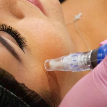 Micro-needling at Empower Aesthetics in Canyon Lake, TX