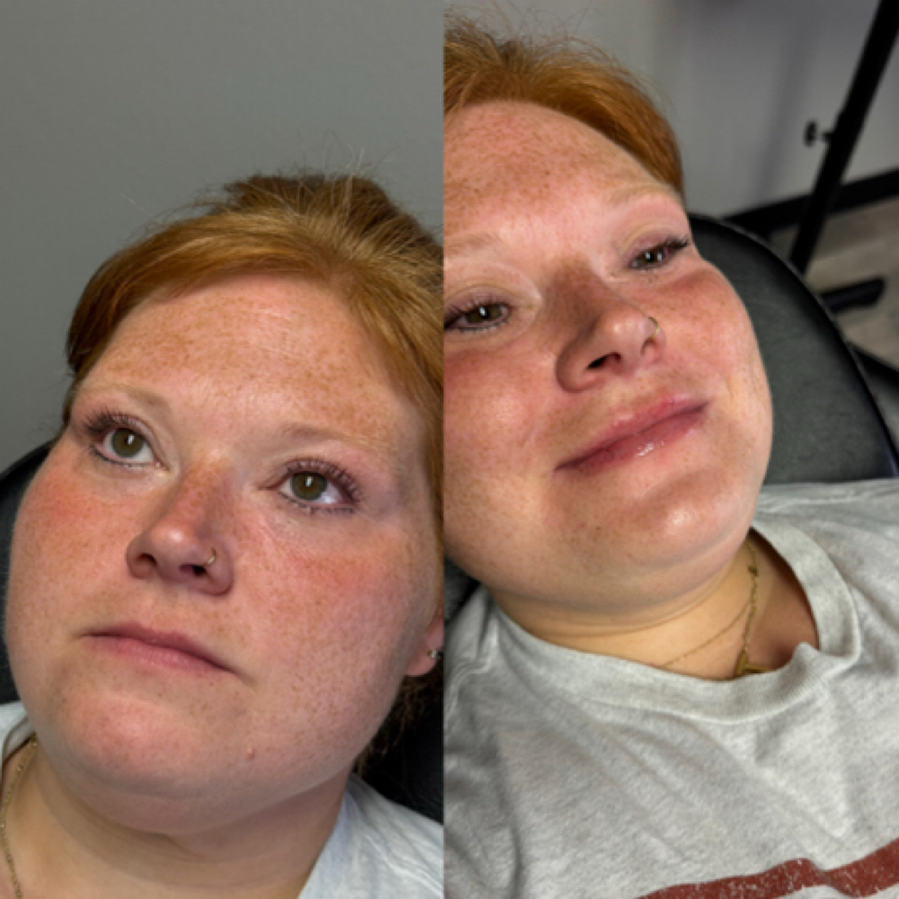 1/2 Syringe Needle Lip Filler at The Beauty Lab in Tyler, TX