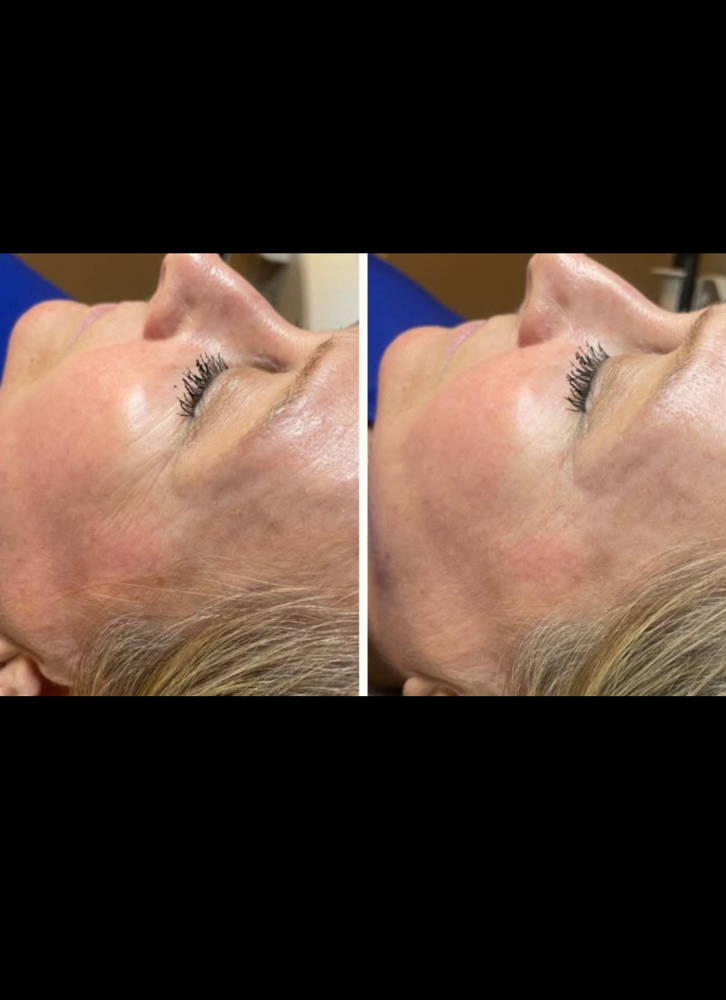 Skin Tightening