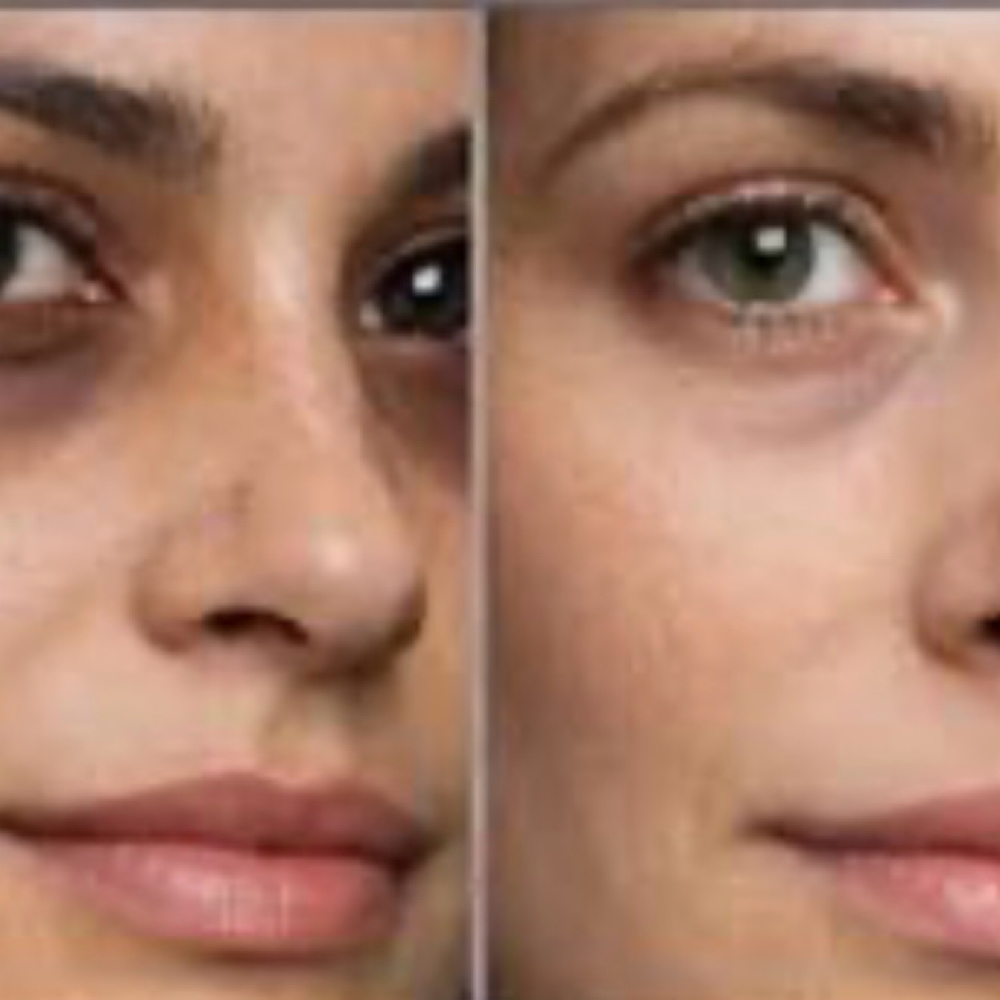 Goodbye Dark Circles-EYE RENEWAL at Ana Aesthetic & Beauty in Freeport, NY