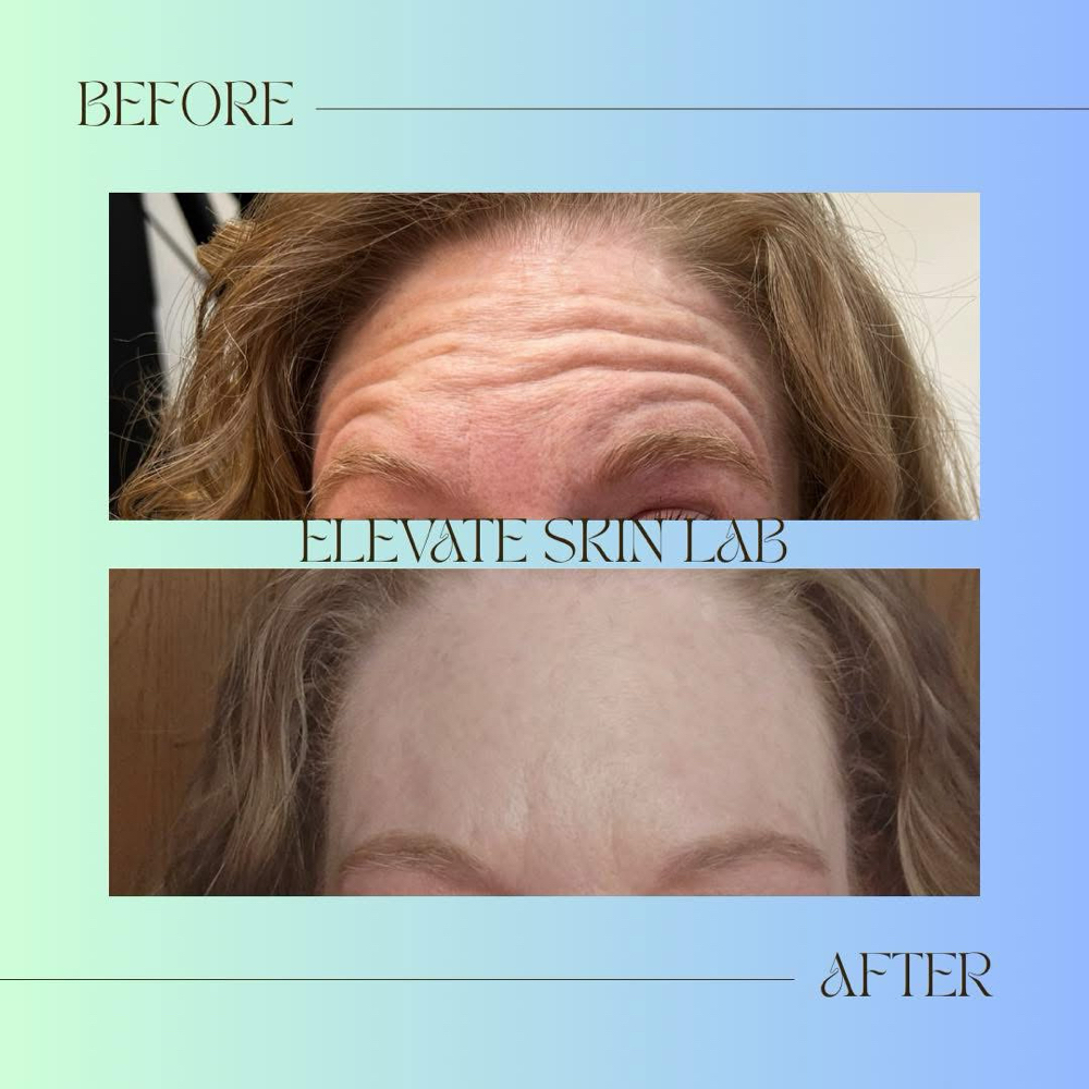 Toxin at Elevate Skin Lab in Desloge, MO