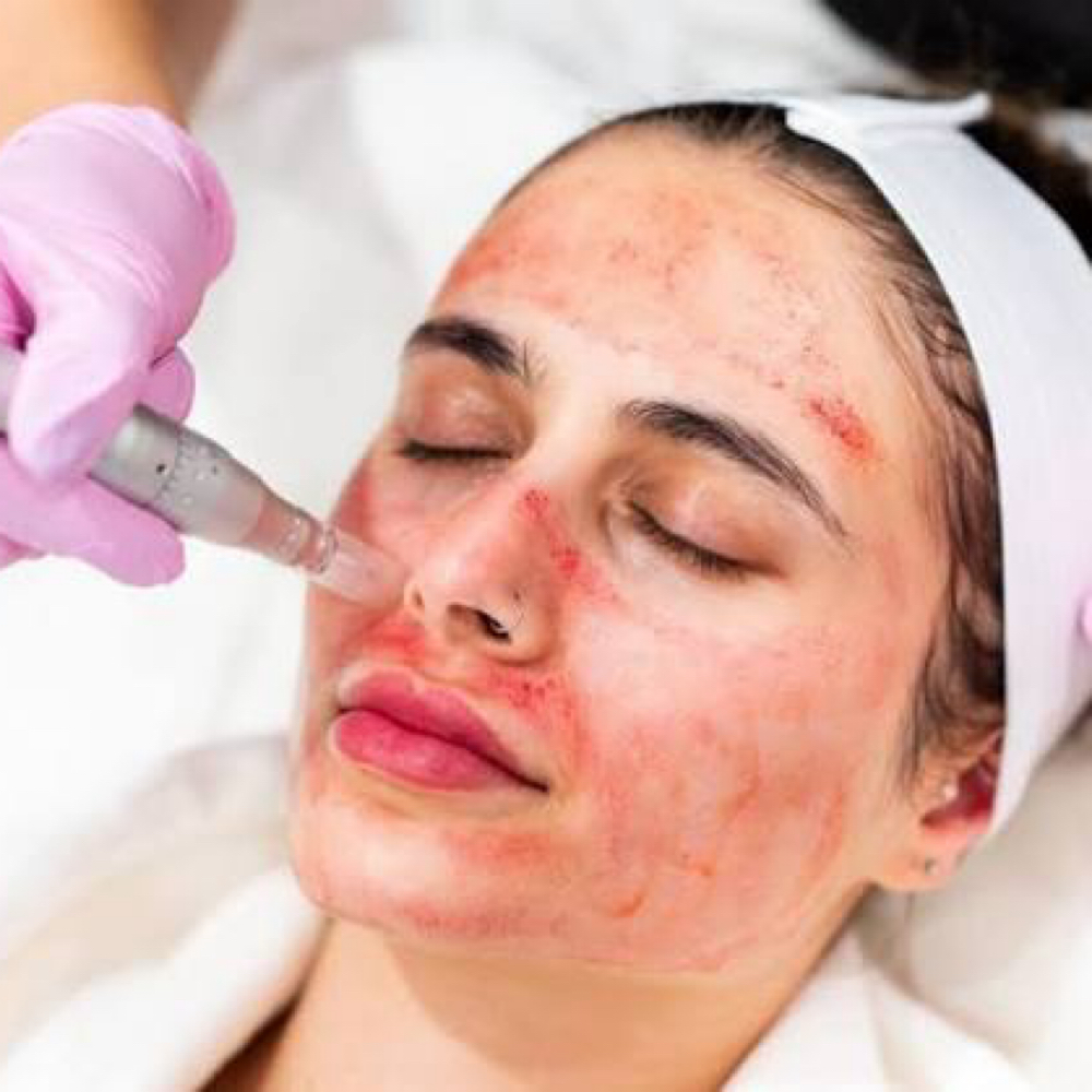 Microneedling + Dermaplaning Facial at Refyned Aesthetics & Wellness in Greenville, TX