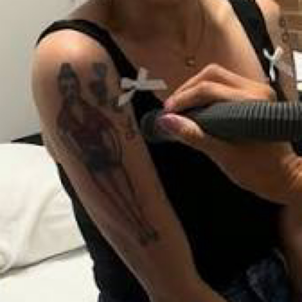 Medium Size Tattoo Removal at Cedar & Sage Aesthetics & Wellness in Hiawassee, GA