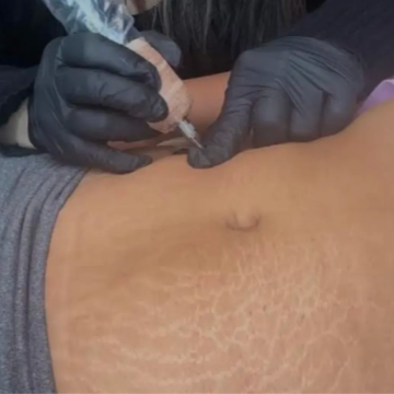 Stretch Mark Camoflauge at Taylor’d Artistry Cosmetics in Santa Maria, CA