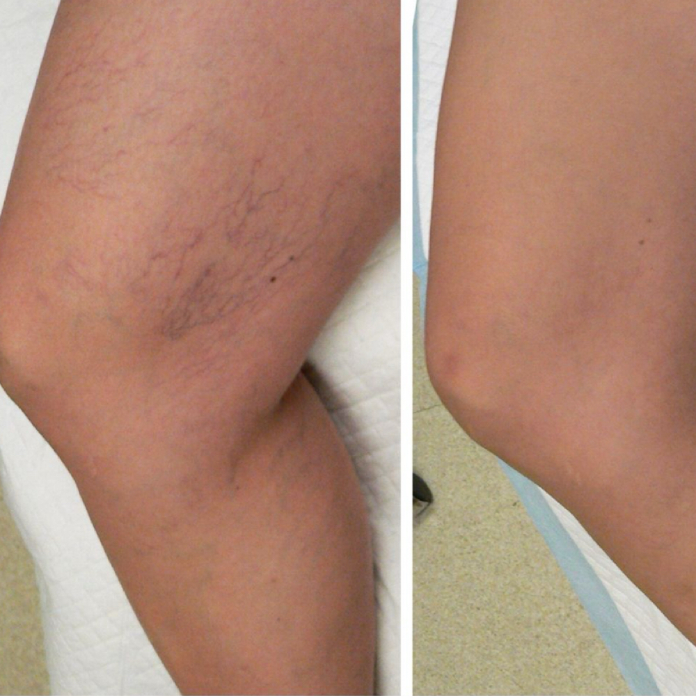LUMECCA BLOOD VESSELS at Remake Beauty Studio Mission in Mission, TX