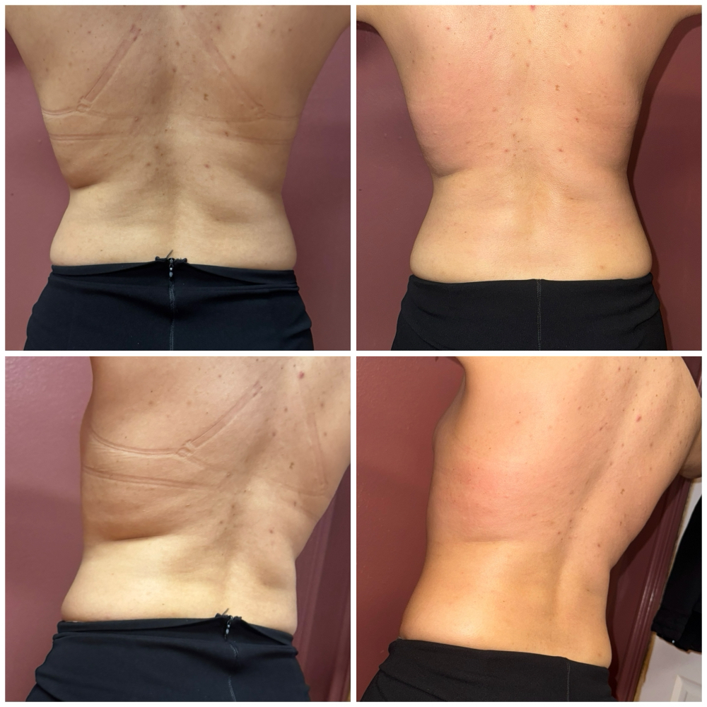 2 Slim Back & 2 Booty Lift at Sculpted by Lluvia in Weslaco, TX