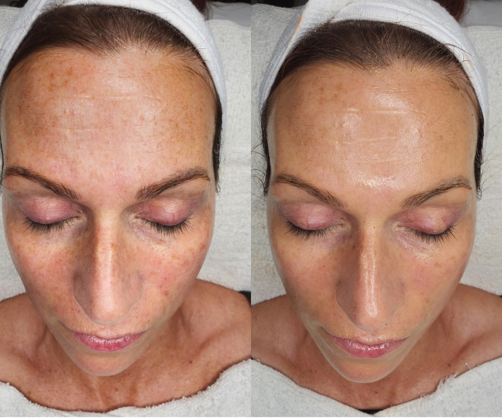 The Glowcation Facial