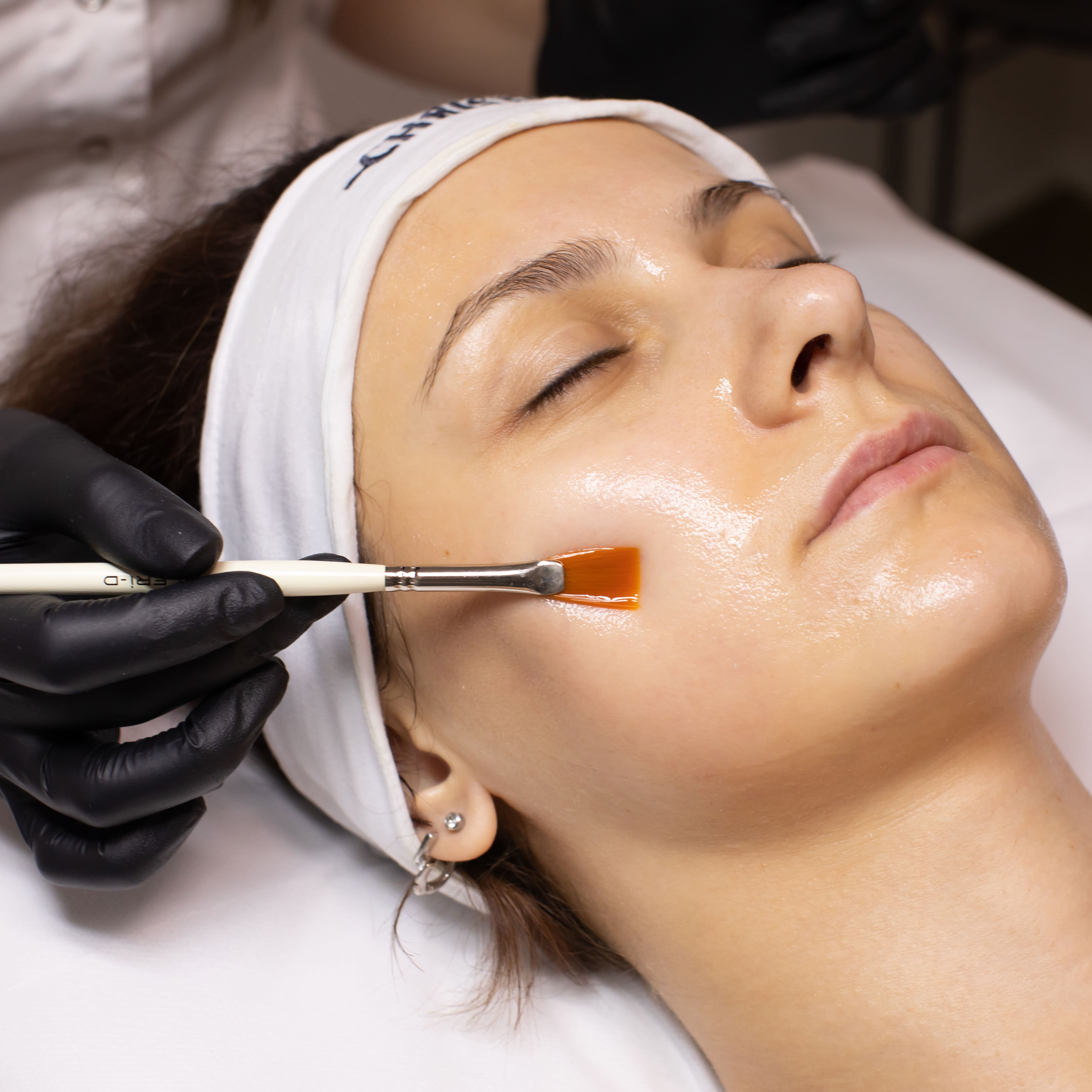 Chemical Peel Enhancement at Dreamland Health and Wellness in Indianapolis, IN