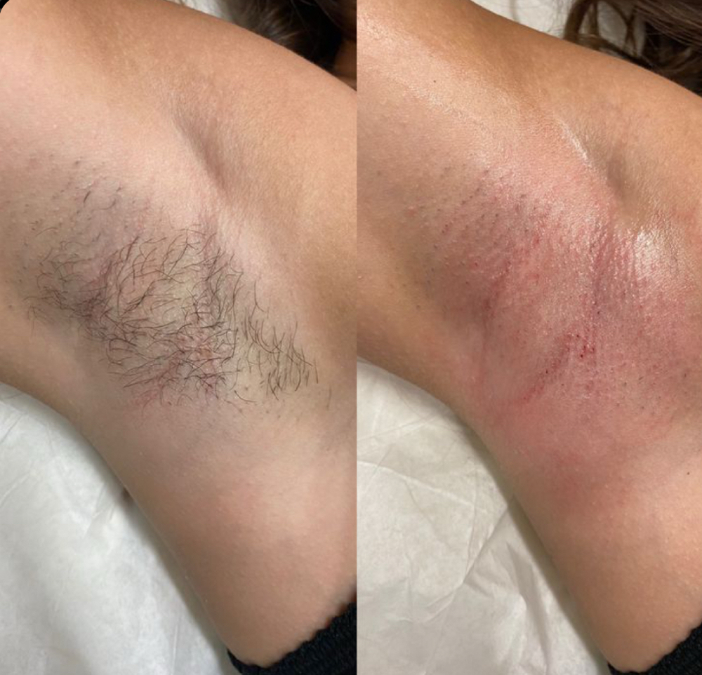 Underarm Wax