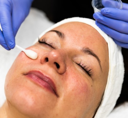 4S Peel Treatment Package